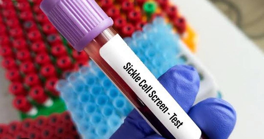 Uganda launches mandatory Sickle Cell screening at birth