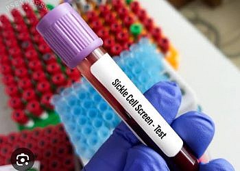 Uganda launches mandatory Sickle Cell screening at birth