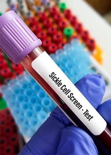 Uganda launches mandatory Sickle Cell screening at birth