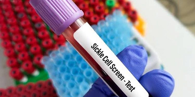 Uganda launches mandatory Sickle Cell screening at birth