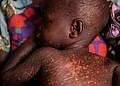 12 deaths recorded as Measles outbreak spreads to 12 districts