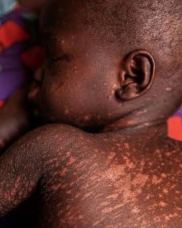 12 deaths recorded as Measles outbreak spreads to 12 districts