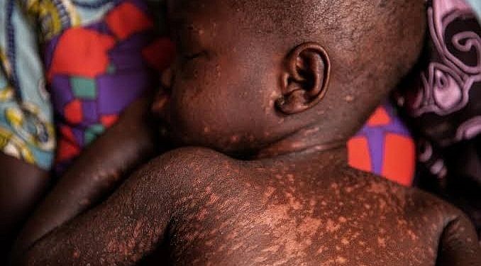 12 deaths recorded as Measles outbreak spreads to 12 districts